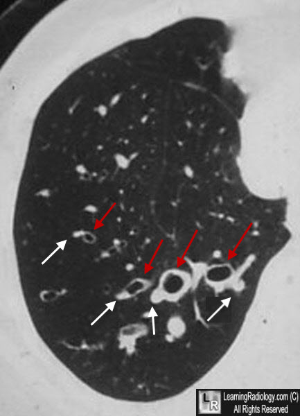 signet ring sign bronchiectasis